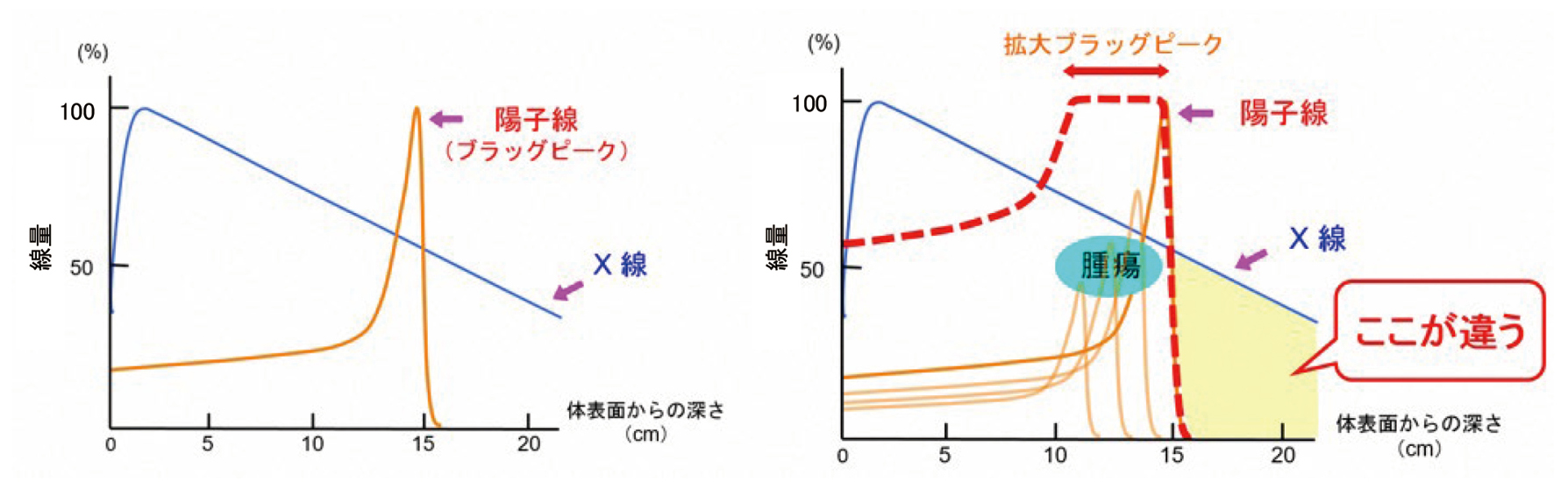 陽子線治療の特徴